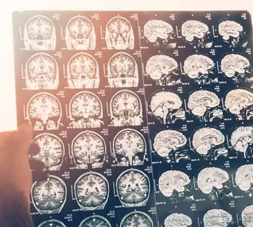 Beyin ve Sinir Cerrahisi (Nöroşirürji)