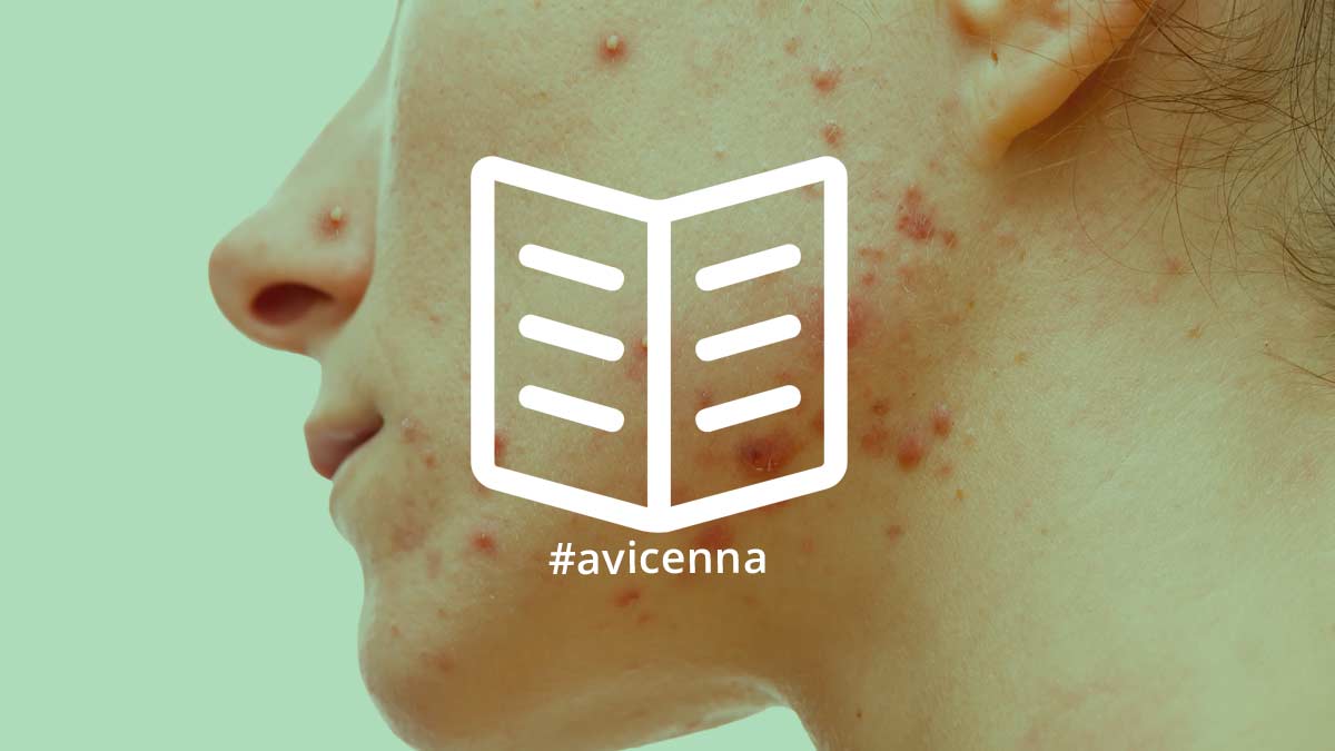 Sivilce: Akne Vulgaris