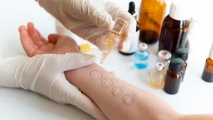 Alerji testi işlemi