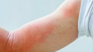 Kurdeşen (Ürtiker) Hastalığı Yaşayan Kişi