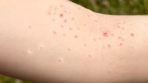 Molluskum Kontagiozum Sorunu Yaşayan Kişi