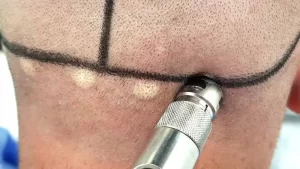 Saç ekiminde son teknoloji