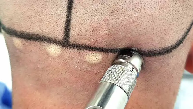 Saç ekiminde son teknoloji