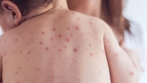 Zona hastalığı geçiren çocuk