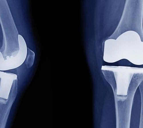 Операция за смяна на тазобедрена става- артропластика (операция на ставно протезиране).