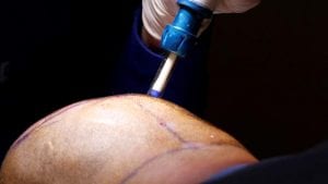 ağrısız saç ekimi