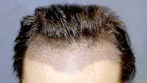 traşsız saç ekimi yapılan erkek