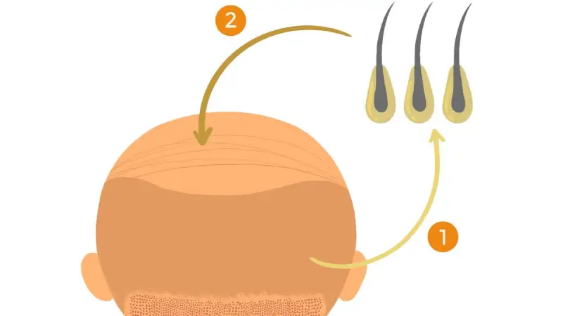 6 maddede saç ekimi aşamaları