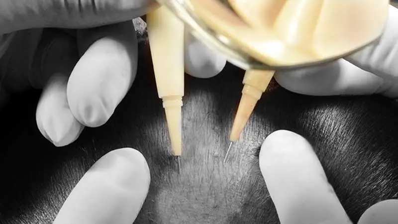 choi saç ekimi yapılan hasta