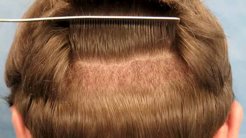 donör bölge örneği