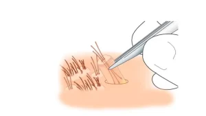 saç ekiminde greft ne demek