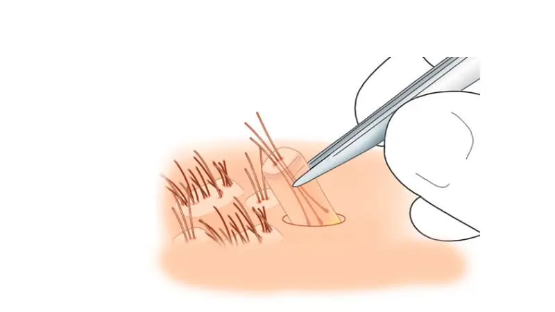 saç ekiminde greft ne demek