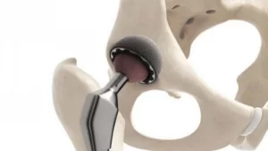 hip replacement