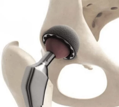 hip replacement