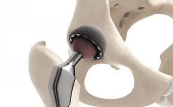 hip replacement