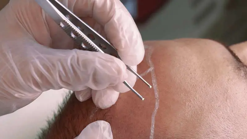 Saç Ekimi Teknikleri Hakkında Bilmeniz Gereken Her Şey