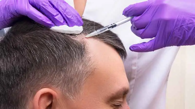 Acell Saç Tedavisi | Acell + PRP Saç Tedavisi