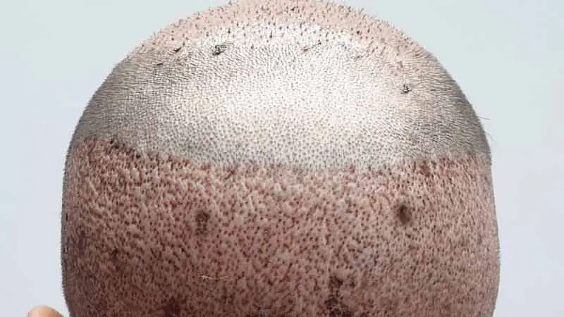 başarısız saç ekimi onarımı