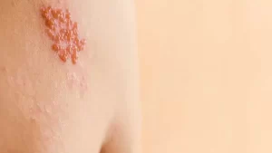 döküntüsüz zona hastalığı