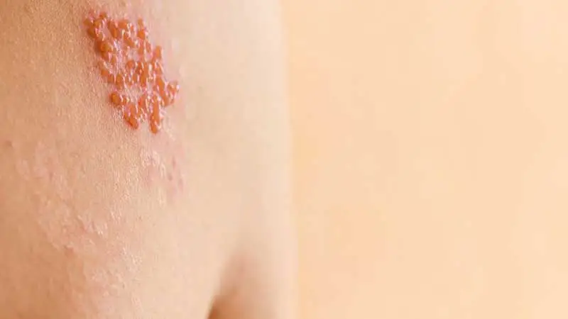 döküntüsüz zona hastalığı