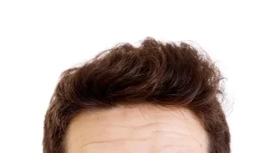 fiber saç ekimi yapılan adam