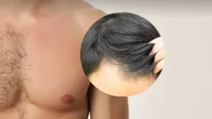 vücut kılından saç ekimi yapılan erkek