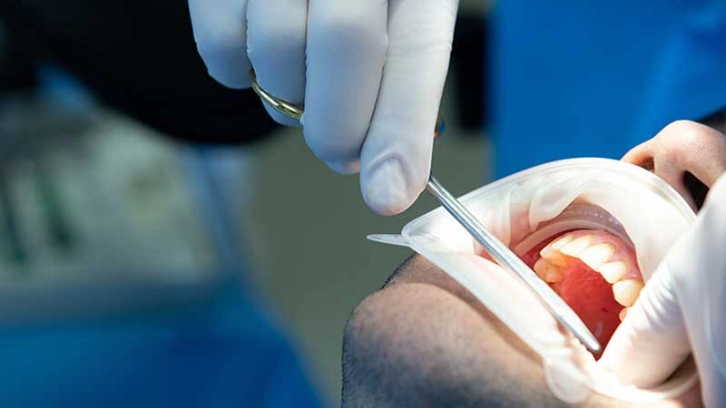 Ağız kanseri tedavisi