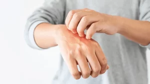 Sedef hastalığı olan kişi