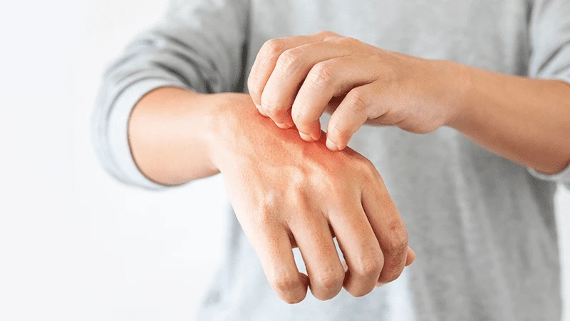 Sedef hastalığı olan kişi