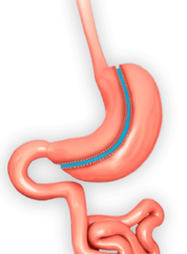 Операция ръкавна гастректомия- метод на извършване, възстановителен период и предимства