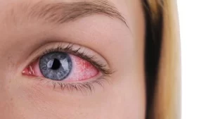 Üveit hastası kadın