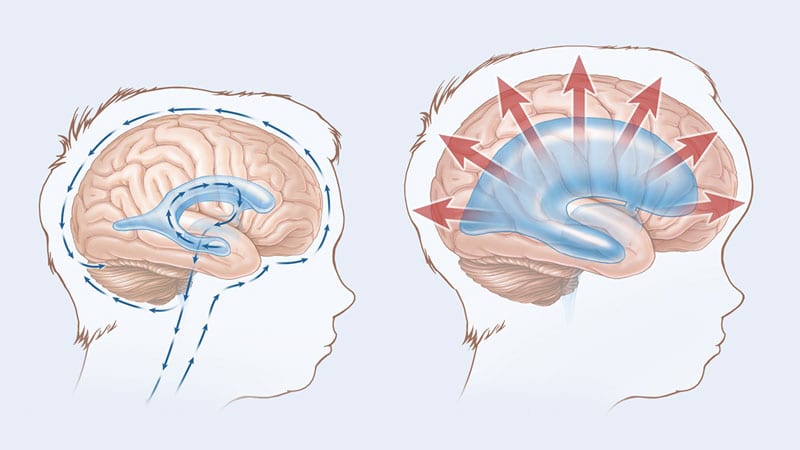 Hidrosefali - Beyinde Su Toplanma