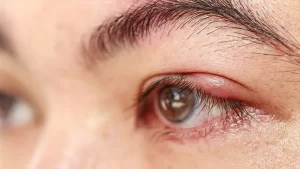 Göz Kapağı İltihabı