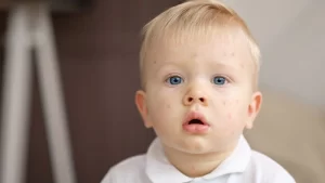 Kızamık olan çocuk