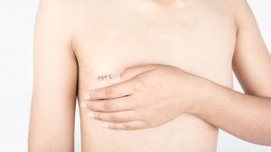 Mastektomi (Mastectomy) ile Meme Kanseri Tedavisi