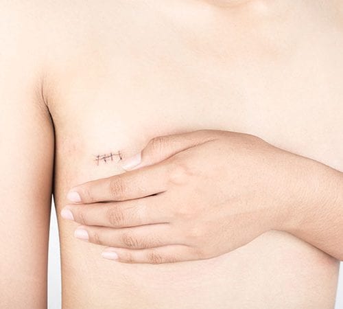 Mastektomi (Mastectomy) ile Meme Kanseri Tedavisi
