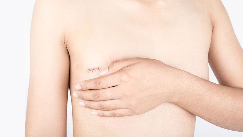 Mastektomi (Mastectomy) ile Meme Kanseri Tedavisi