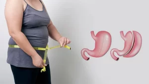 Gastrektomi Kolu Ameliyatı