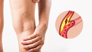 Periferik arter hastalığı