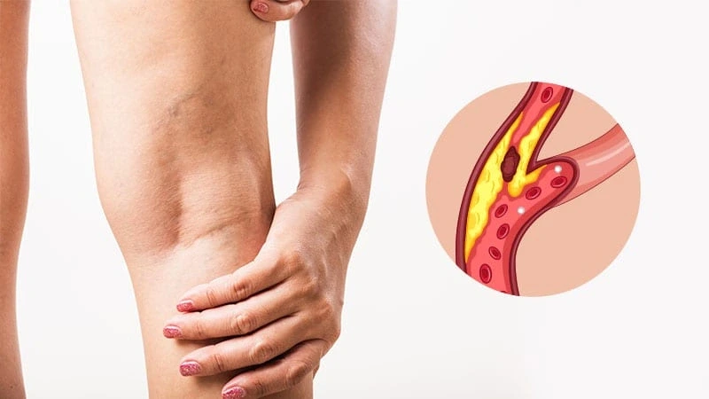 Periferik arter hastalığı