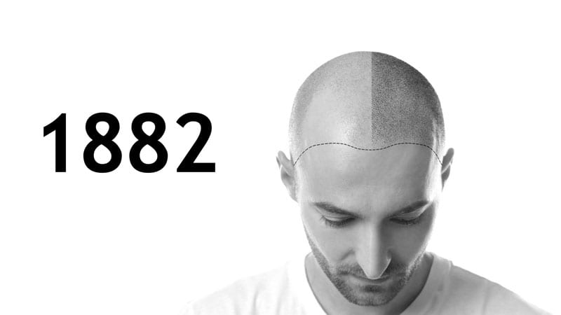 تاريخ زراعة الشعر 1882