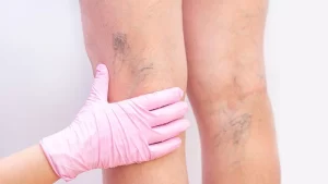 Varis sorunu olan kişi