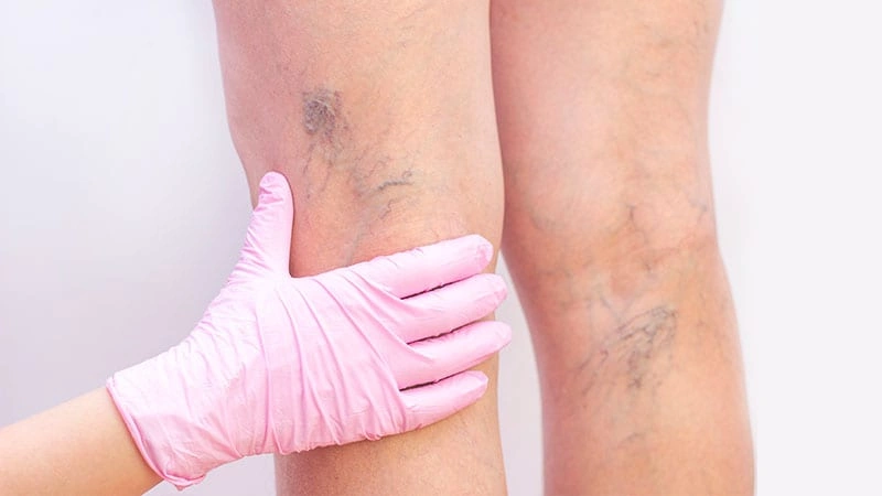 Varis sorunu olan kişi