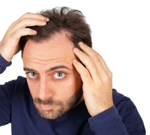sac-cizgisinin-gerilemesi-e Saç Çizgisinin Gerilemesi