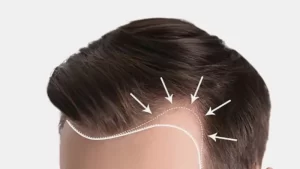 Saç Ekiminde Saç Çizgisinin Önemi