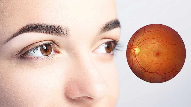 Sarı nokta hastalığı