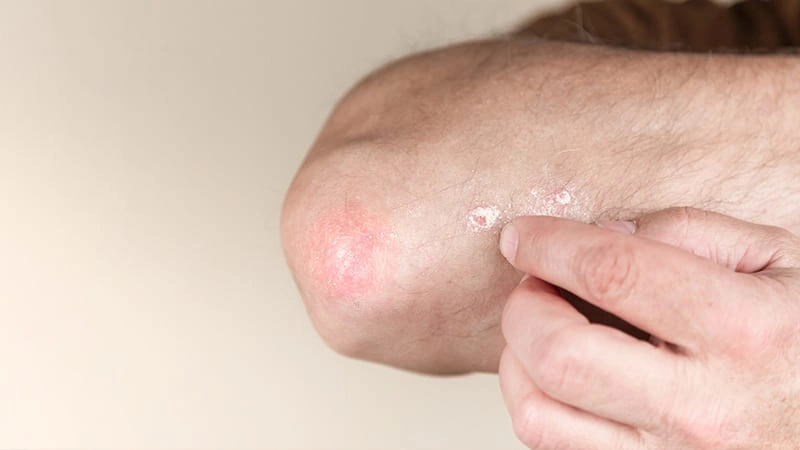 Seboreik Dermatit Hastalığı Olan Kişi