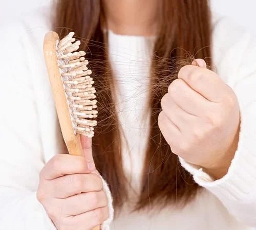 Traksiyonel Alopesi Hastası Kadın