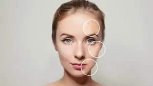 Cilt lekeleri problemi yaşayan kadın