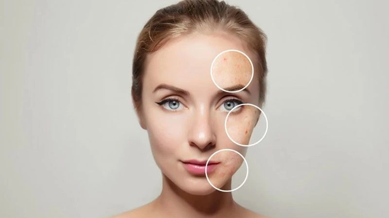 Cilt lekeleri problemi yaşayan kadın